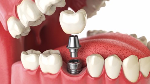 Dental Implants in Surrey